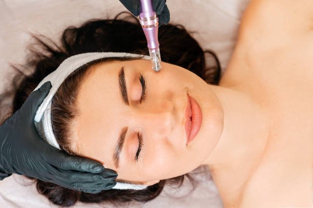 How Long Do Microneedling Results Last?