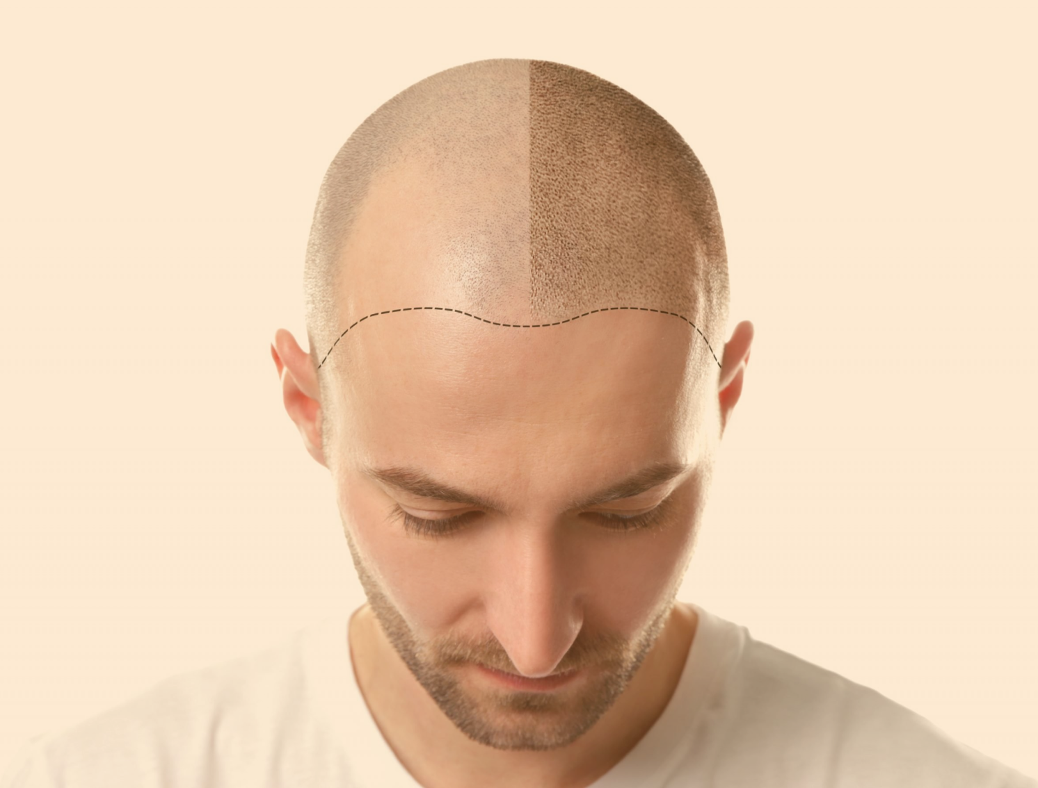 How Long Does Scalp Micropigmentation Last?