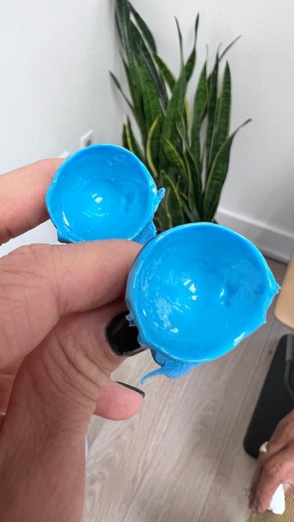 Keratoconus Our Office Was Established to Provide Exceptional Care for Keratoconus, and the Majority of Our Patients Have This Disease The Keratoconus Experts in Charlotte Where Advanced Technology Meets Compassionate Care Around 75% of patients at the Charlotte Contact Lens Institute have keratoconus, a condition that is one of our primary focuses, setting us apart