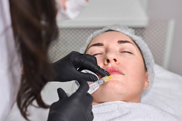 Defined Lips Shape with Russian Lip Fillers