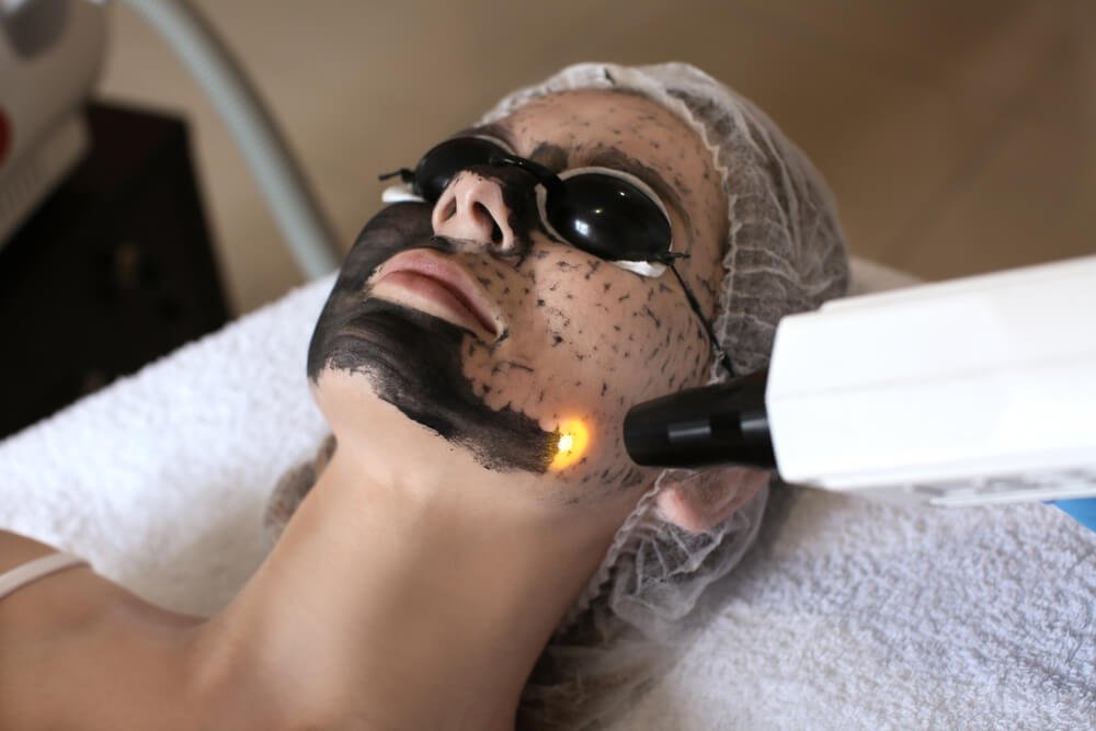 Does Laser Carbon Peel Tighten Open Pores