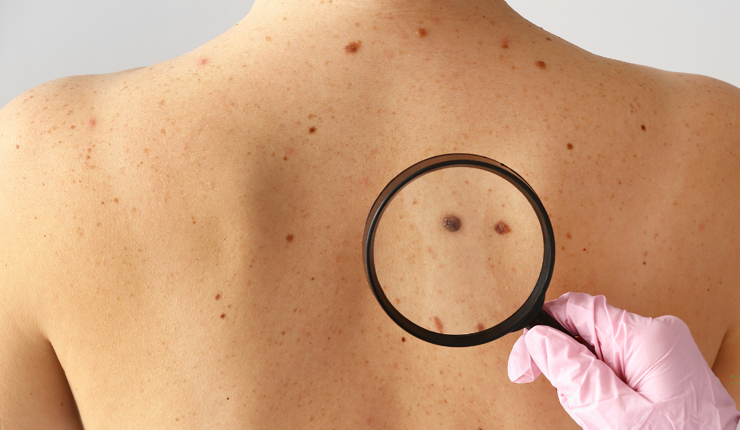Does Mole Removal Leave Any Scars Behind?