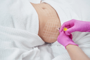 How Do Fat Melting Injections Target Small Areas?