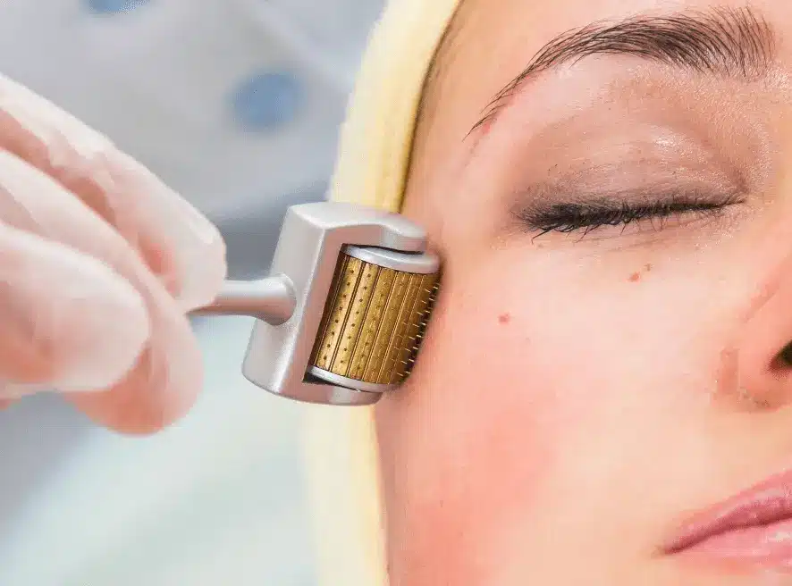 How Effective Is Derma Roller Treatment Today?