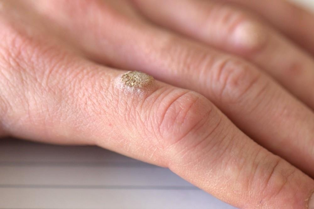 How Long Does Warts Removal Treatment Take