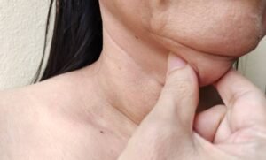 Is Double Chin Removal Effective Without Surgery