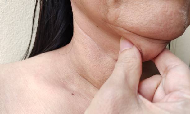 Is Double Chin Removal Effective Without Surgery