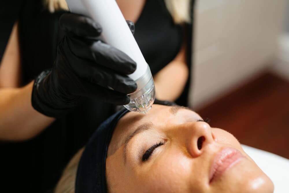 Is Microneedling Good for Uneven Skin Tone?