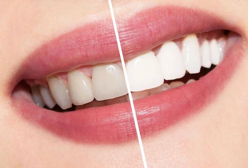 Teeth Whitening Services in Dural