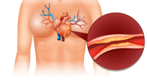ct coronary angiography price