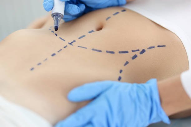 What Makes Liposuction Surgery a Top Choice?
