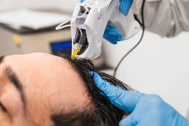 Hair Transplant in Riyadh