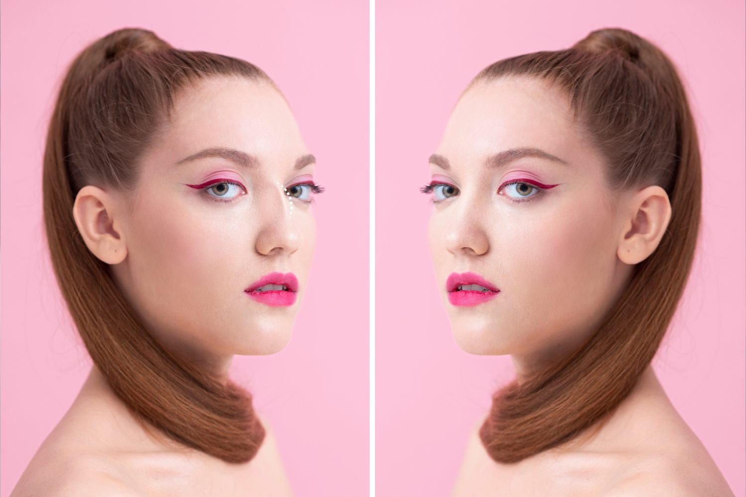 rhinoplasty before and after