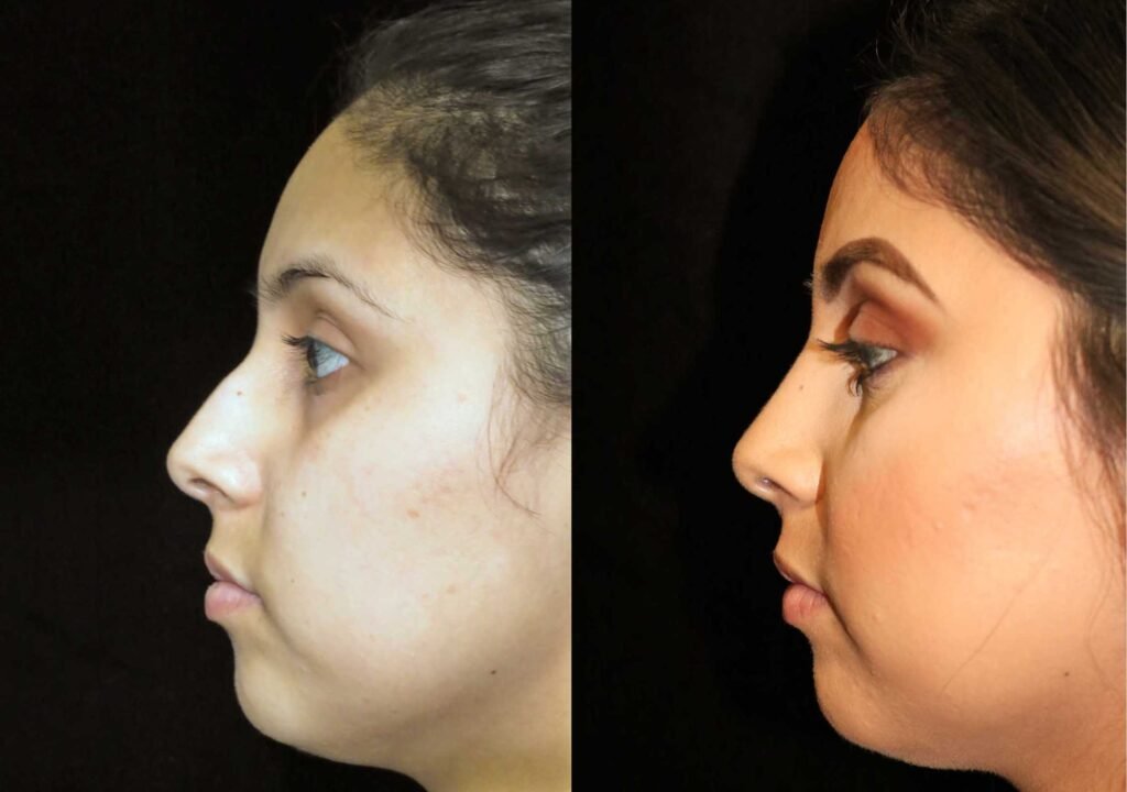 تجميل الأنف في دبي
