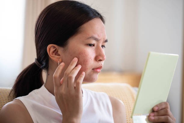 How Does Laser Acne Treatment Remove Scars?