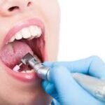 Why Regular Dental Scale and Polish Matters for Gum Health