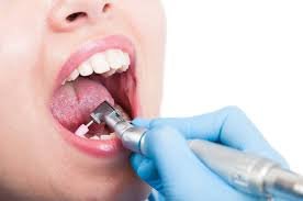 dental scale and polish