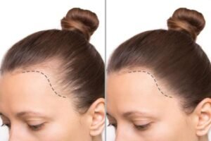 زراعة الشعر في دبي